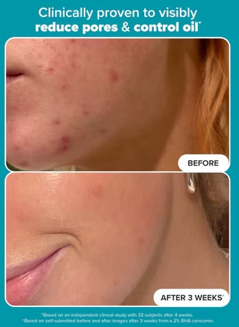 đĽLAST DAY 49% OFFâ¨ODEIUNâ˘- Skin Perfecting 2% BHA Liquid Exfoliant