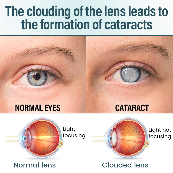 🔥Timilk® OptiFusion Nano Eye Drops Serum —Nano Technology Restores Clear Vision, No Glasses, No Surgery