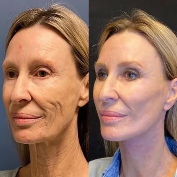 Last Day Promotion 49% OFF - š„Botox Face Serum