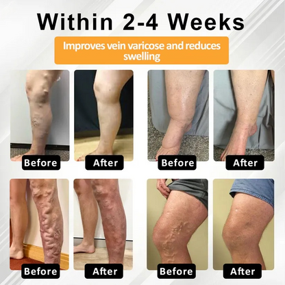 ODEIUN® MicroSting Bee Vein Ease Patches